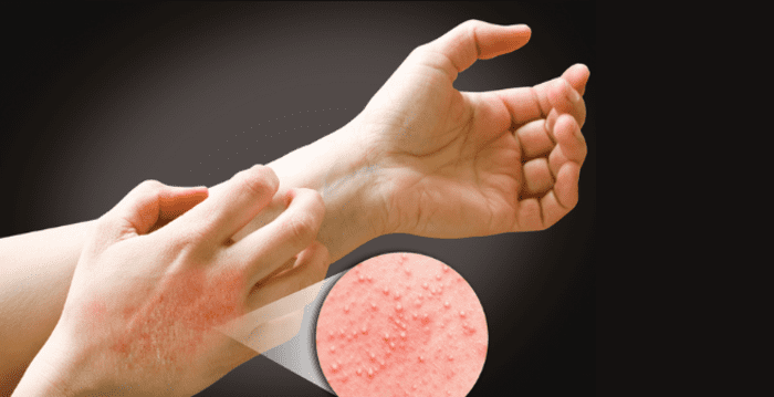 Khi có hiện tượng dị ứng khi đeo bao tay y tế, bạn cần tháo găng và xử lý phù hợp