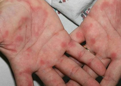 Nổi mẩn ngứa xuất hiện nhiều khi bị dị ứng bột găng tay y tế