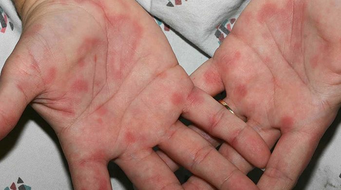 Nổi mẩn ngứa xuất hiện nhiều khi bị dị ứng bột găng tay y tế