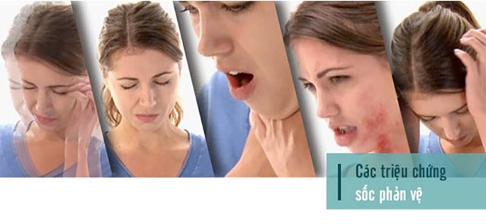 Sốc phản vệ là biểu hiện nguy hiểm nhưng rất hiếm gặp với dị ứng bột găng tay y tế